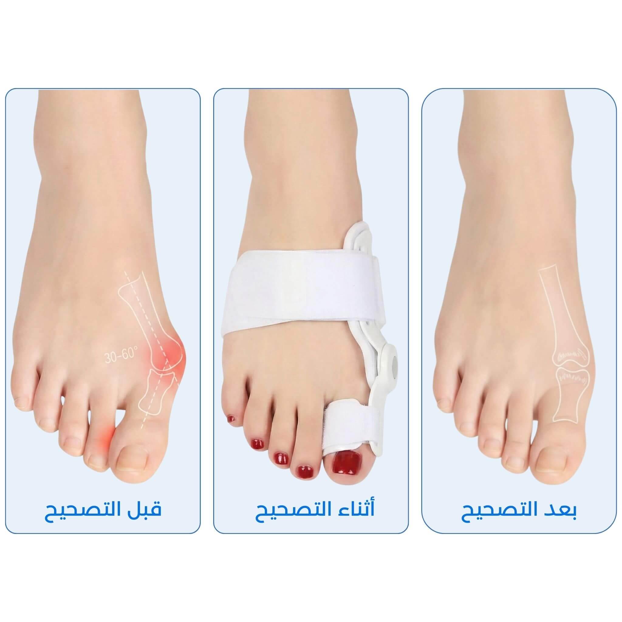 مصحح إبهام القدم الطبي - وداعاً للألم