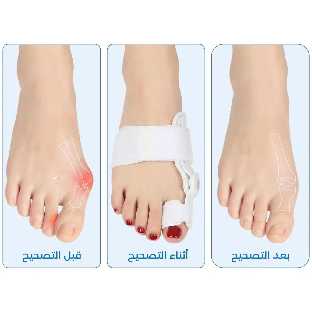 مصحح إبهام القدم الطبي - وداعاً للألم - Al - boukhary